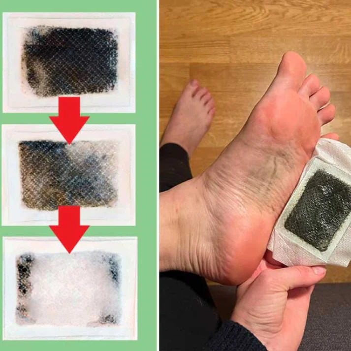 Used Xuhaha foot pads shown after overnight wear beside a foot with a removed pad